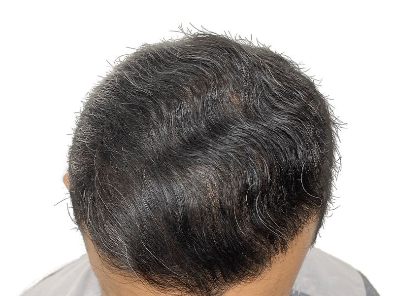 Thinning dark hair with gray. Receding hairline. Potential hair restoration candidate. Before hair transplant consideration.