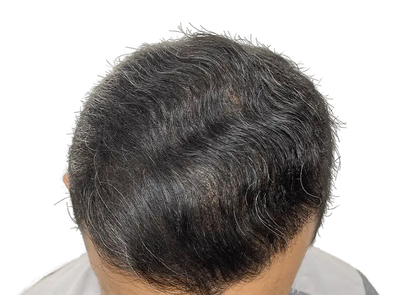 Thinning dark hair with gray. Receding hairline. Potential hair restoration candidate. Before hair transplant consideration.
