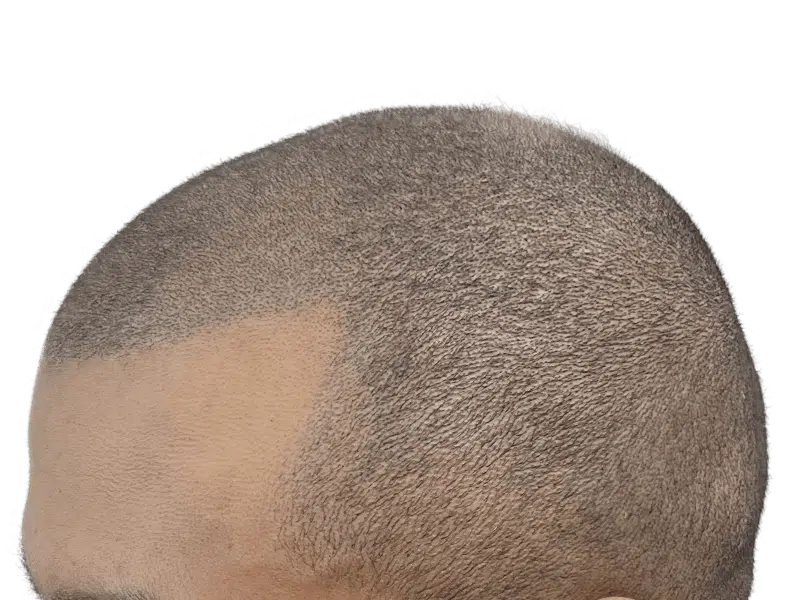Hair transplant result: African American/Hispanic male with dense, restored hairline. Before/after hair restoration success.