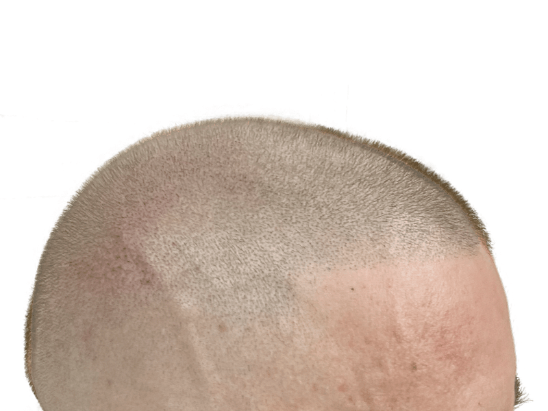 Hair transplant result: Close-up of scalp showing even hair density and natural hairline. Hair restoration success.