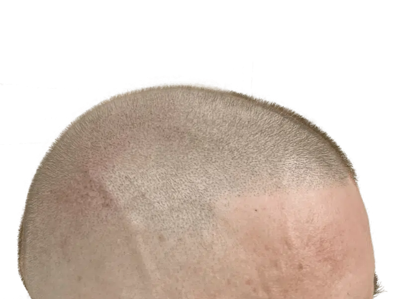 Hair transplant result: Close-up of scalp showing even hair density and natural hairline. Hair restoration success.