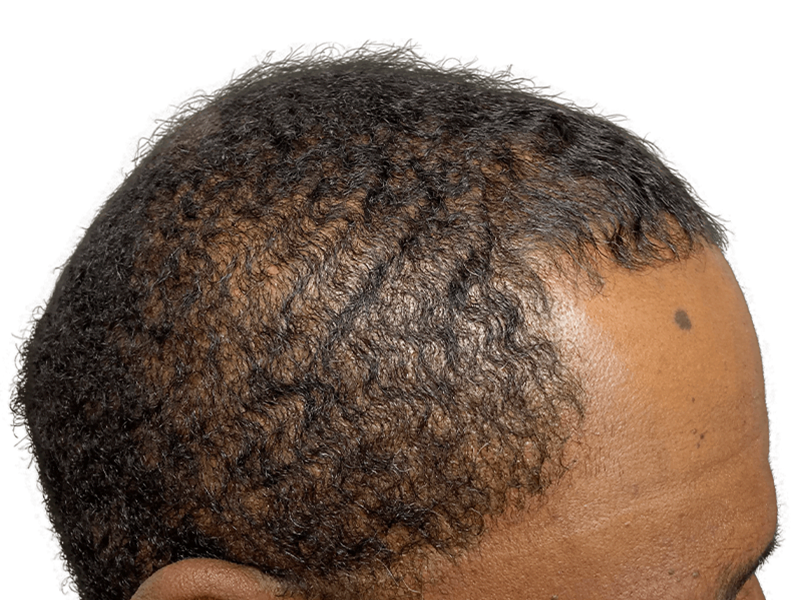 Before hair transplant: African American man with thinning hairline. Hair restoration candidate.