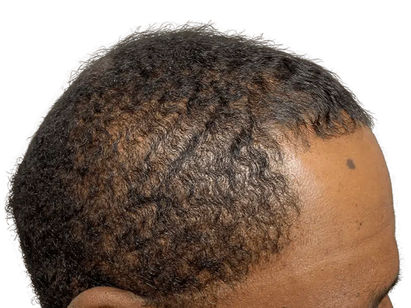 Before hair transplant: African American man with thinning hairline. Hair restoration candidate.