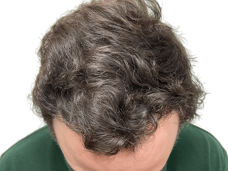 Thinning dark hair at crown. Potential hair loss. Consider hair restoration or transplant options. Before treatment example.