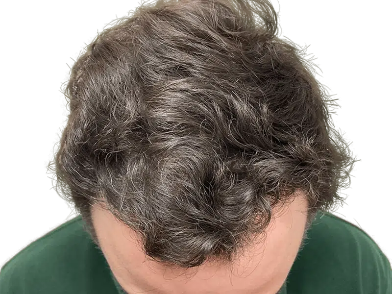 Thinning dark hair at crown. Potential hair loss. Consider hair restoration or transplant options. Before treatment example.