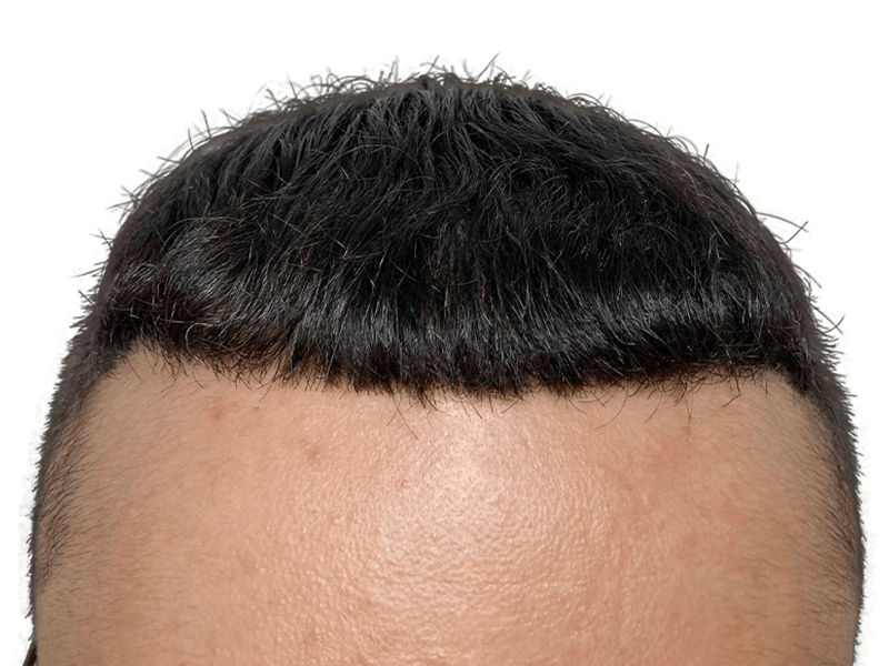 Hair transplant result: Dark hair, improved hairline. Caucasian man's forehead showing hair restoration success. Before/after comparison available.