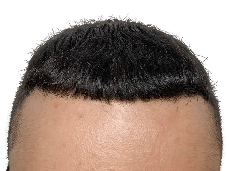 Hair transplant result: Dark hair, improved hairline. Caucasian man's forehead showing hair restoration success. Before/after comparison available.