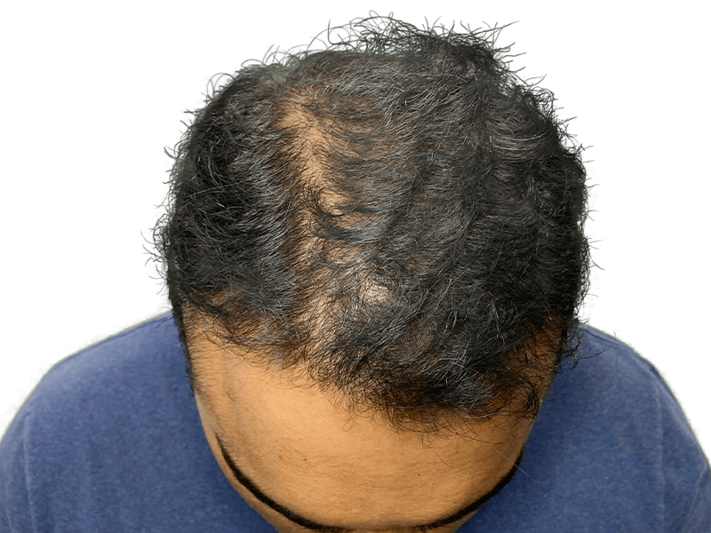Before hair transplant: Thinning dark, curly hair at the crown and hairline. Hair restoration candidate.