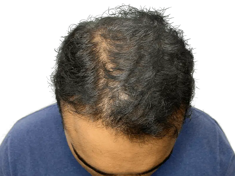 Before hair transplant: Thinning dark, curly hair at the crown and hairline. Hair restoration candidate.