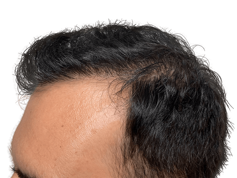 Hair transplant result: Asian man's fuller hairline. Before/after hair restoration procedure. Dark, thick hair; improved density.
