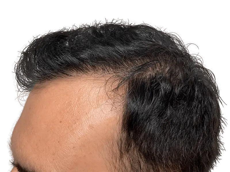 Hair transplant result: Asian man's fuller hairline. Before/after hair restoration procedure. Dark, thick hair; improved density.