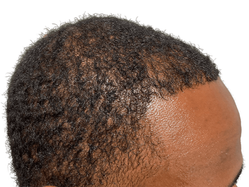 Hair transplant result on African American man. Improved hairline, denser hair. Hair restoration procedure success.