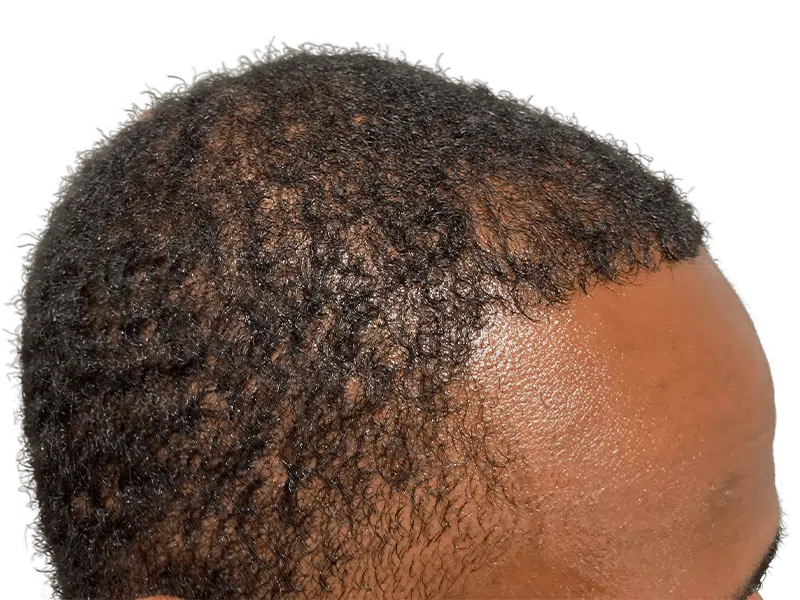 Hair transplant result on African American man. Improved hairline, denser hair. Hair restoration procedure success.