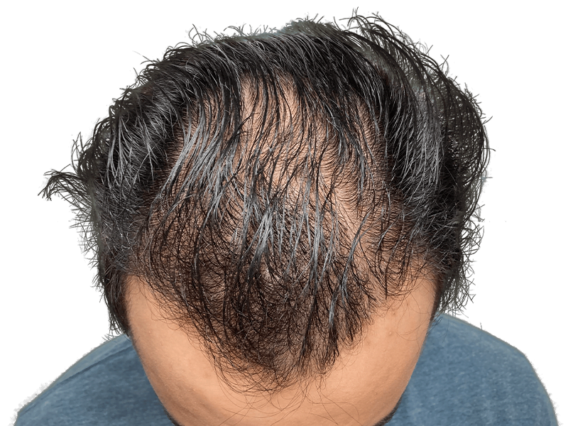 Thinning dark hair (Asian descent). Potential hair loss. Could be a hair transplant before/after. Hair restoration option.