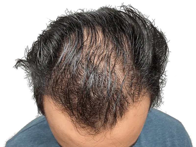 Thinning dark hair (Asian descent). Potential hair loss. Could be a hair transplant before/after. Hair restoration option.
