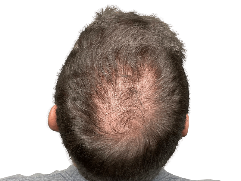 Thinning hair & bald spot on back of head. Hair restoration or transplant consult? Before/after results may vary.