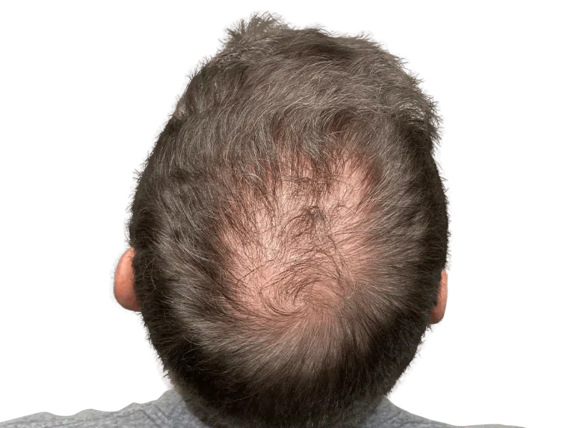 Thinning hair & bald spot on back of head. Hair restoration or transplant consult? Before/after results may vary.