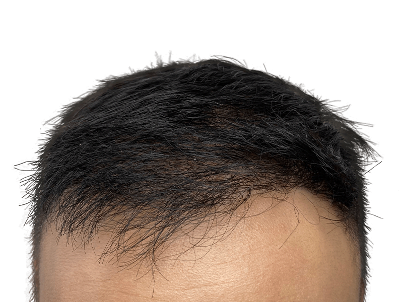 Hair restoration result: Asian man's hairline. Possible hair transplant for thinning hair. Before/after comparison needed.