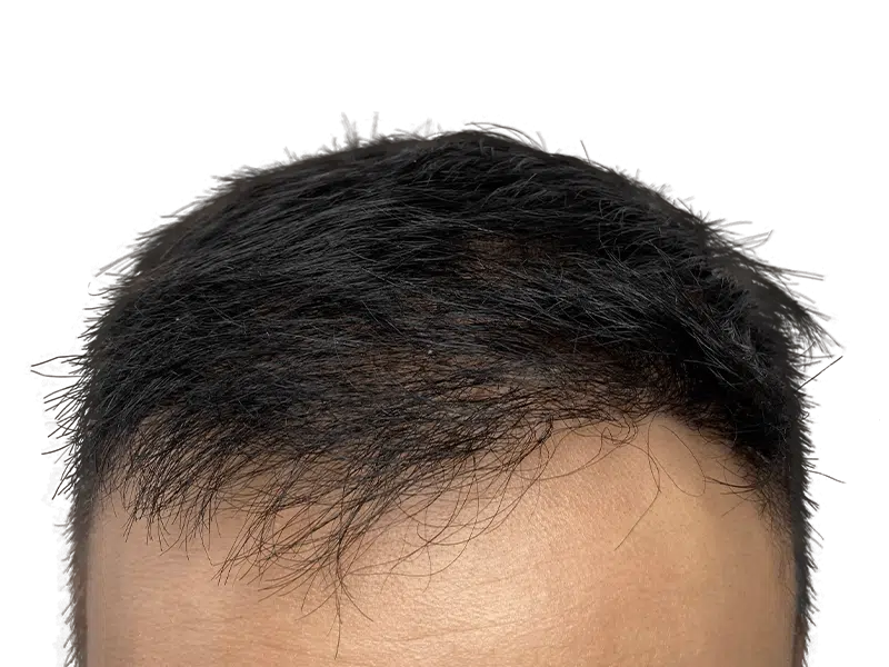Hair restoration result: Asian man's hairline. Possible hair transplant for thinning hair. Before/after comparison needed.