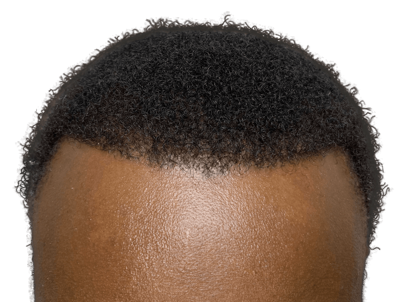 Hair transplant result: African American man's restored hairline. Dense, natural-looking hair after hair restoration procedure.