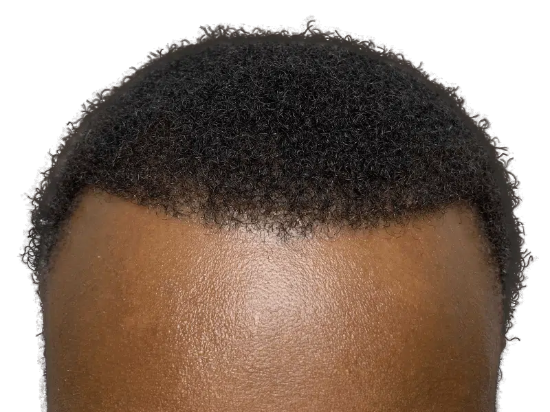 Hair transplant result: African American man's restored hairline. Dense, natural-looking hair after hair restoration procedure.