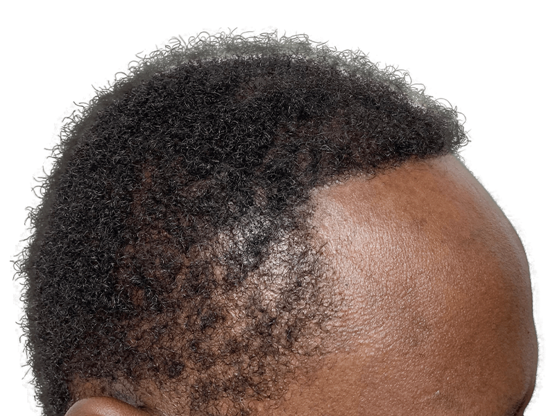 Hair transplant results: African American man's hairline showing thicker hair after restoration procedure.