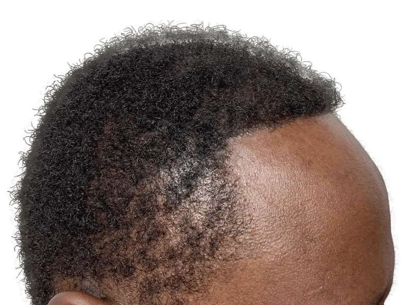 Hair transplant results: African American man's hairline showing thicker hair after restoration procedure.