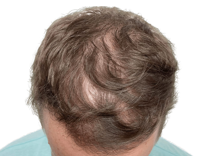 Thinning brown hair with bald spots. Potential hair restoration candidate. Before hair transplant. Crown and temple balding.
