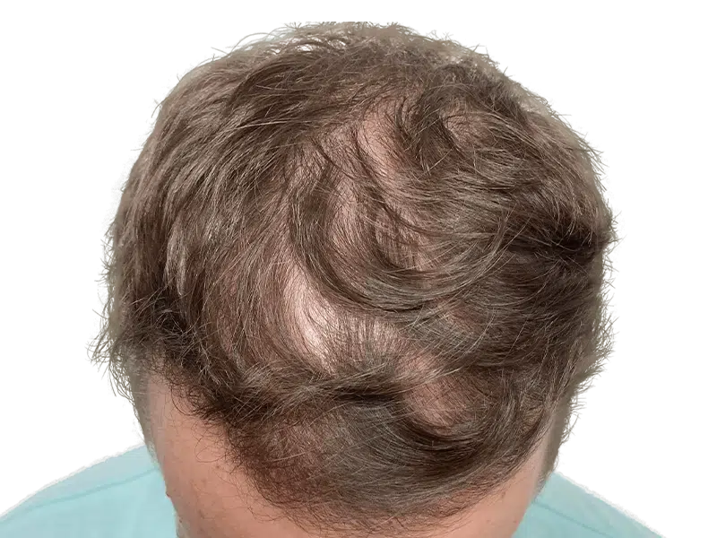 Thinning brown hair with bald spots. Potential hair restoration candidate. Before hair transplant. Crown and temple balding.