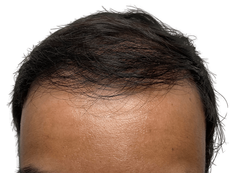 Thinning hairline (Asian male). Potential hair loss. Consult for hair restoration & transplant options.