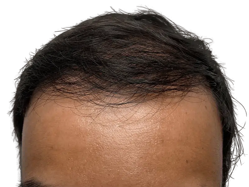 Thinning hairline (Asian male). Potential hair loss. Consult for hair restoration & transplant options.