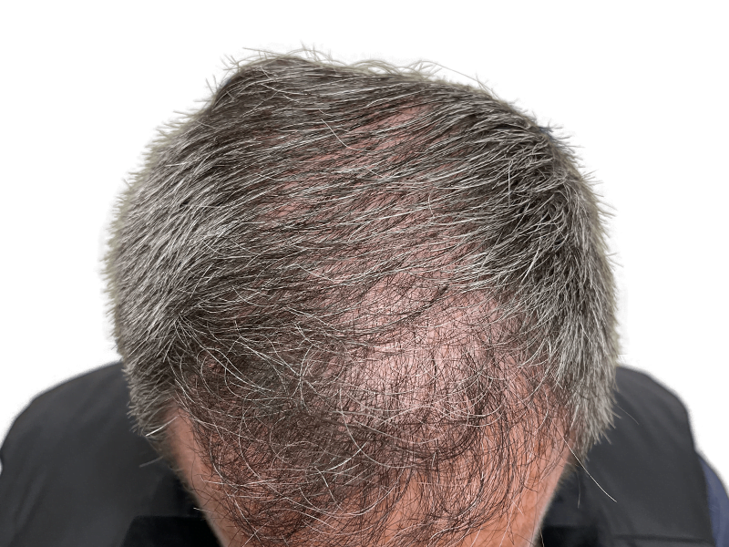 Thinning gray hair on fair skin. Potential hair restoration candidate. Consider hair transplant options for fuller hair.