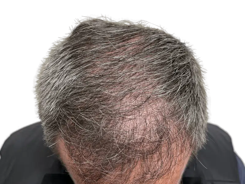 Thinning gray hair on fair skin. Potential hair restoration candidate. Consider hair transplant options for fuller hair.