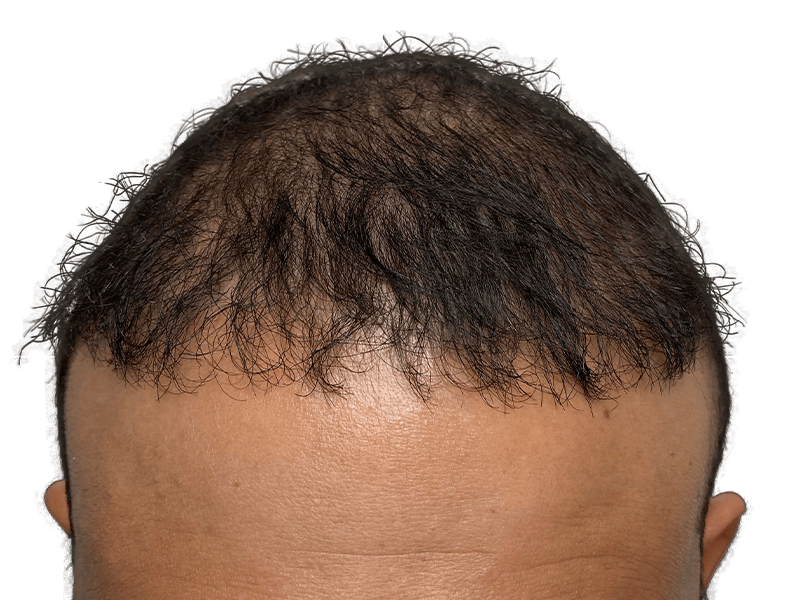 Hair transplant result: Dark hair restoration on receding hairline. Before/after example for Hispanic/African American patient.
