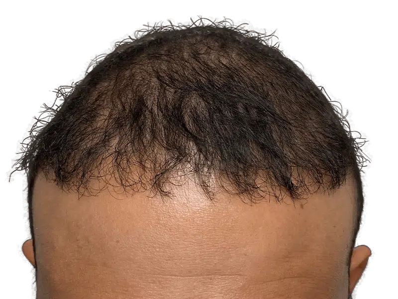 Hair transplant result: Dark hair restoration on receding hairline. Before/after example for Hispanic/African American patient.