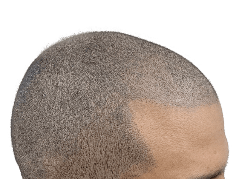 Hair transplant result: Gray hair restored on shaved head. Caucasian male. Before/after hair restoration success.