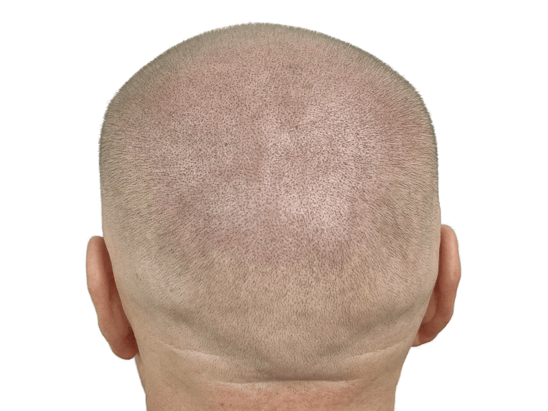 Hair transplant result: Evenly distributed hair growth on back of head. Successful hair restoration procedure.