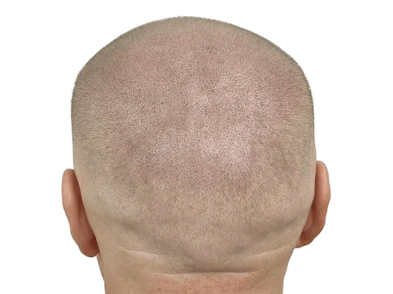 Hair transplant result: Evenly distributed hair growth on back of head. Successful hair restoration procedure.