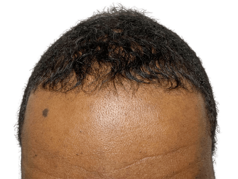 Receding hairline in African American man. Hair transplant before. Hair restoration services available.