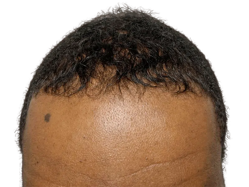 Receding hairline in African American man. Hair transplant before. Hair restoration services available.