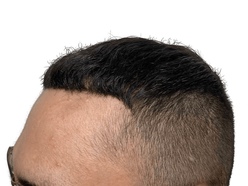 Hair transplant result: Dark hair, improved hairline. Caucasian male. Hair restoration success. Before/after possible.