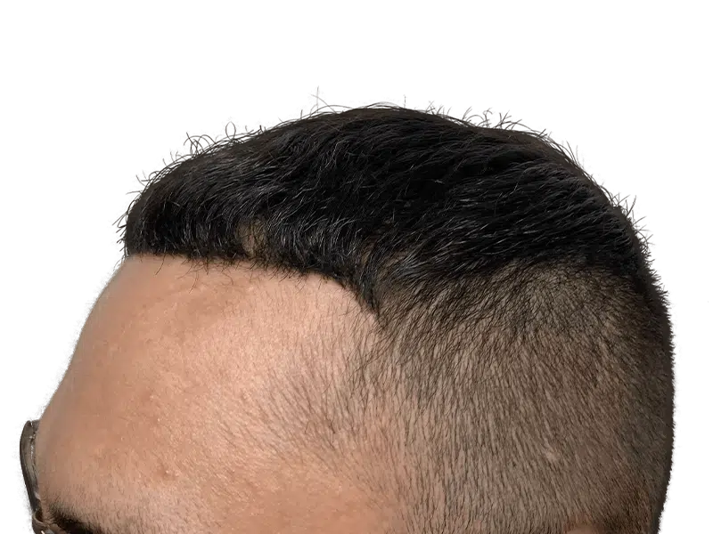 Hair transplant result: Dark hair, improved hairline. Caucasian male. Hair restoration success. Before/after possible.