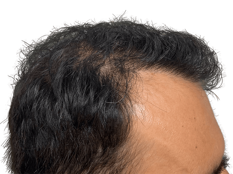 Before hair transplant: Thinning dark hair and visible scalp. Hair restoration candidate. Shows hair loss problem.