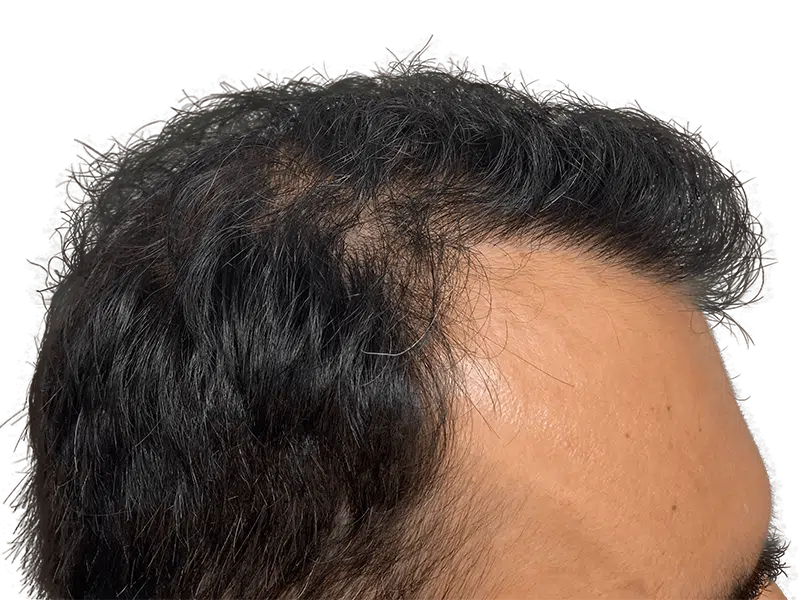 Before hair transplant: Thinning dark hair and visible scalp. Hair restoration candidate. Shows hair loss problem.