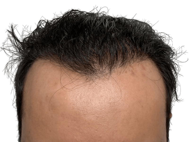 Before hair transplant: Hispanic/Middle Eastern hairline. Fine hairs visible. Hair restoration potential shown.