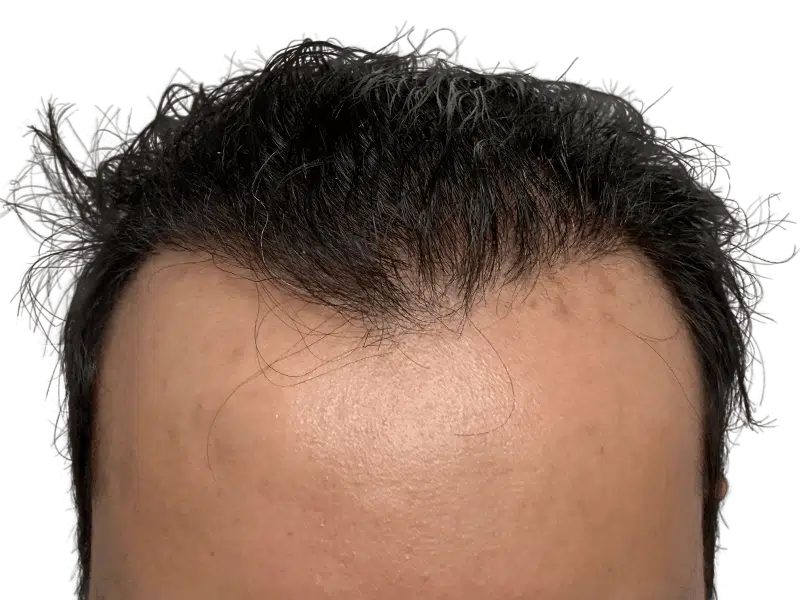 Before hair transplant: Hispanic/Middle Eastern hairline. Fine hairs visible. Hair restoration potential shown.