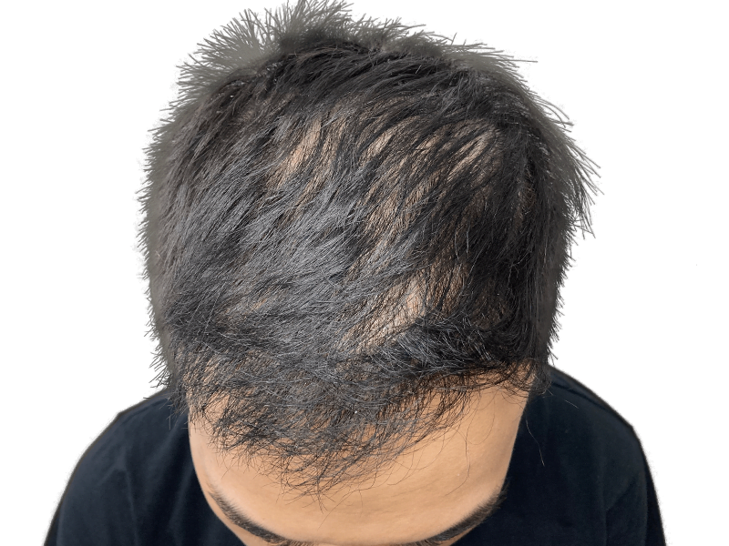 Thinning dark hair, receding hairline. Potential hair loss candidate. Consider hair restoration options. Before treatment.