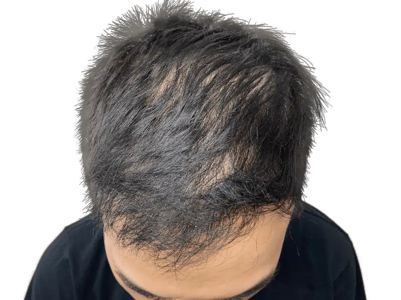 Thinning dark hair, receding hairline. Potential hair loss candidate. Consider hair restoration options. Before treatment.