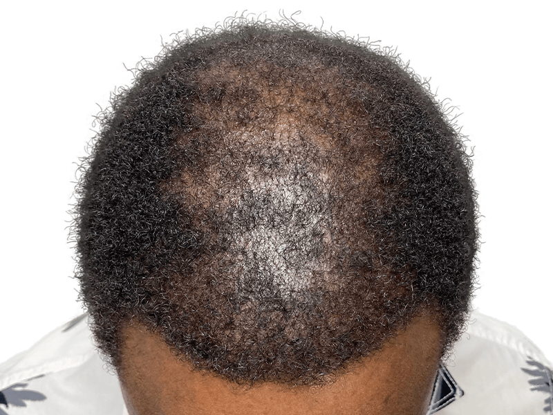 Hair thinning crown (African American/Hispanic). Possible hair transplant before. Black, curly hair. Hair restoration option.