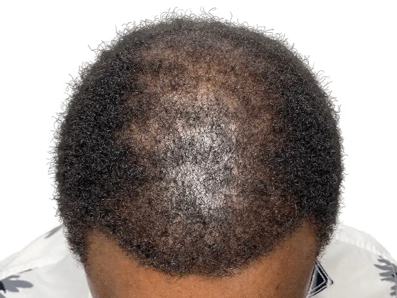 Hair thinning crown (African American/Hispanic). Possible hair transplant before. Black, curly hair. Hair restoration option.